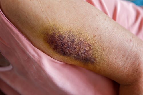 Bruises, Fractures, and Fear of Staff How Physical Abuse Cases Often Present in Atlanta Nursing Homes